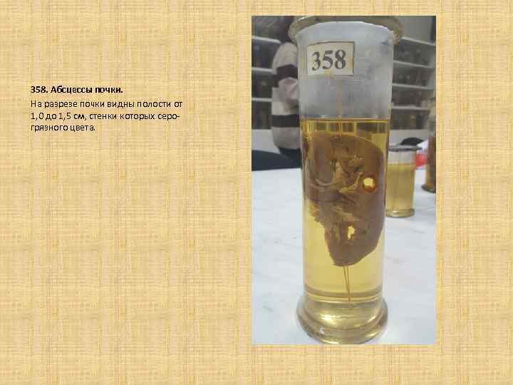 358. Абсцессы почки. На разрезе почки видны полости от 1, 0 до 1, 5
