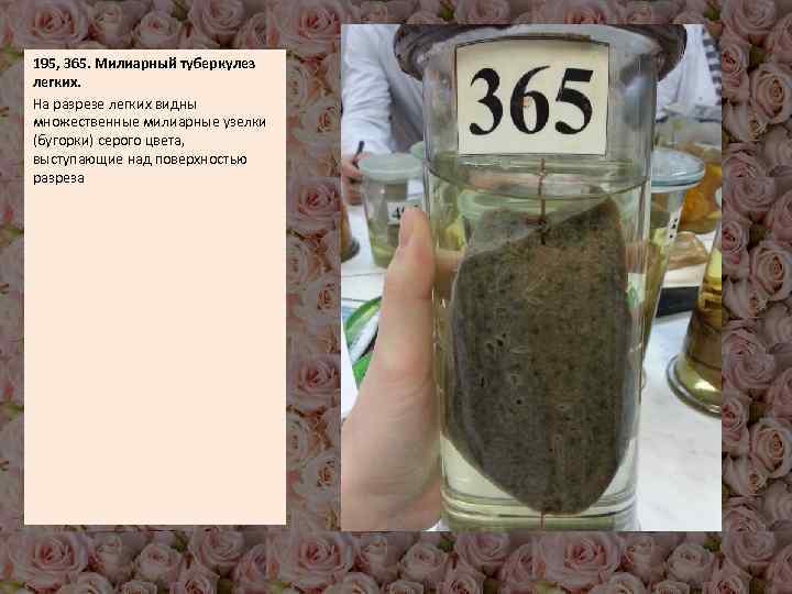 195, 365. Милиарный туберкулез легких. На разрезе легких видны множественные милиарные узелки (бугорки) серого