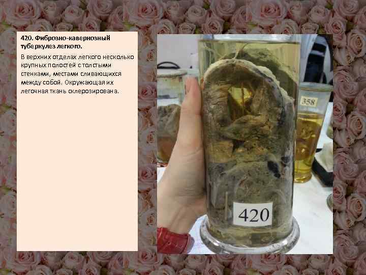 420. Фиброзно-кавернозный туберкулез легкого. В верхних отделах легкого несколько крупных полостей с толстыми стенками,