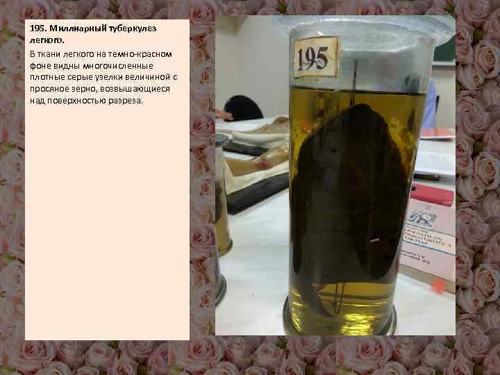 195. Миллиарный туберкулез легкого. В ткани легкого на темно-красном фоне видны многочисленные плотные серые