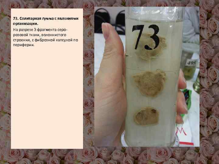  73. Солитарная гумма с явлениями организации. На разрезе 3 фрагмента серорозовой ткани, волокнистого