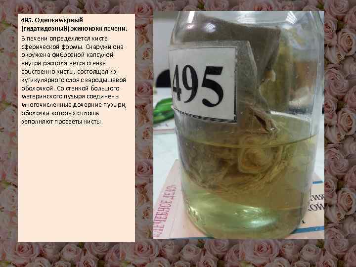 495. Однокамерный (гидатидозный) эхинококк печени. В печени определяется киста сферической формы. Снаружи она окружена