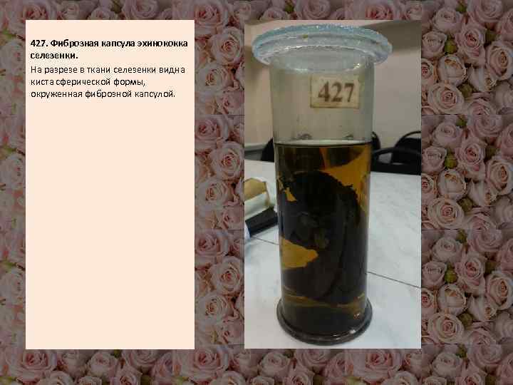  427. Фиброзная капсула эхинококка селезенки. На разрезе в ткани селезенки видна киста сферической