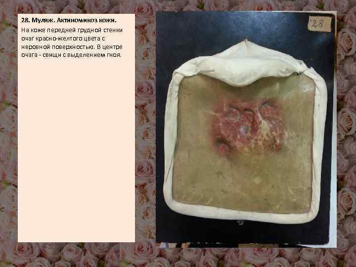 28. Муляж. Актиномикоз кожи. На коже передней грудной стенки очаг красно-желтого цвета с неровной
