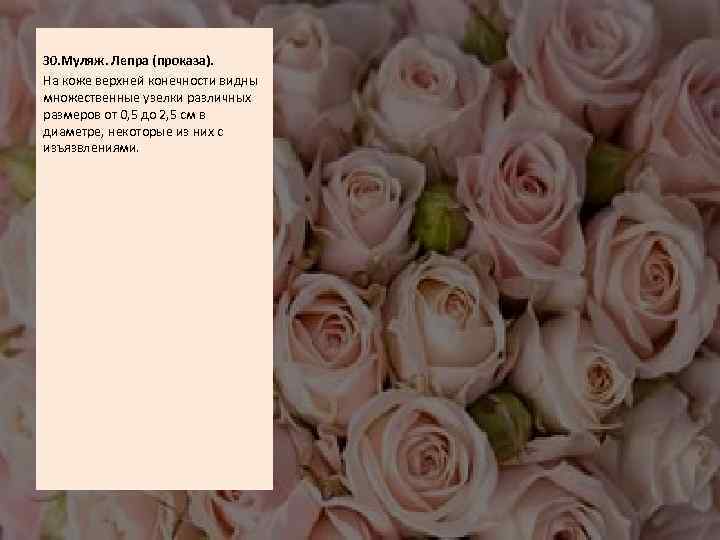  30. Муляж. Лепра (проказа). На коже верхней конечности видны множественные узелки различных размеров