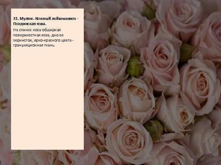  32. Муляж. Кожный лейшманиоз Пендинская язва. На спинке носа обширная поверхностная язва, дно