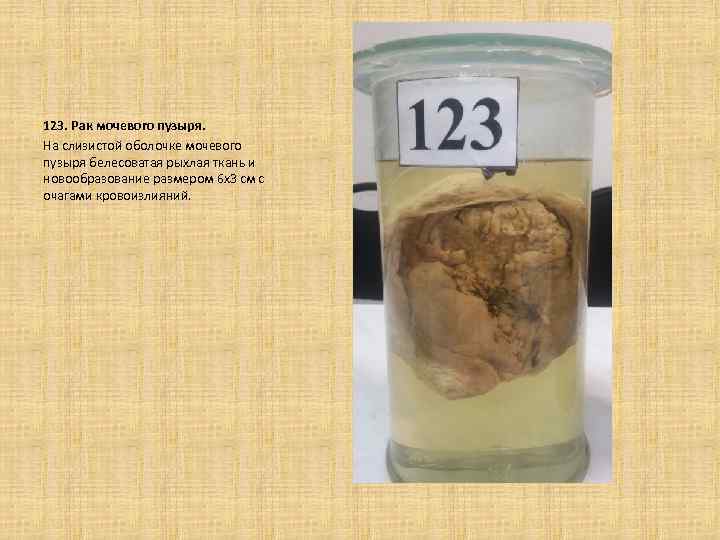123. Рак мочевого пузыря. На слизистой оболочке мочевого пузыря белесоватая рыхлая ткань и новообразование