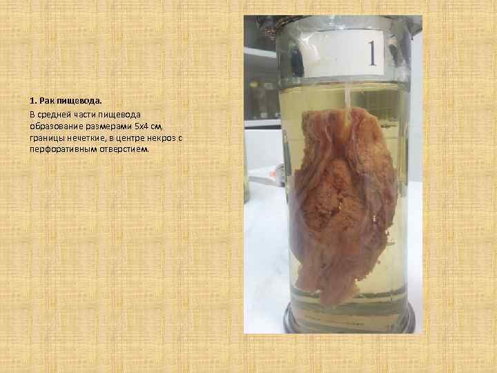  1. Рак пищевода. В средней части пищевода образование размерами 5 х4 см, границы