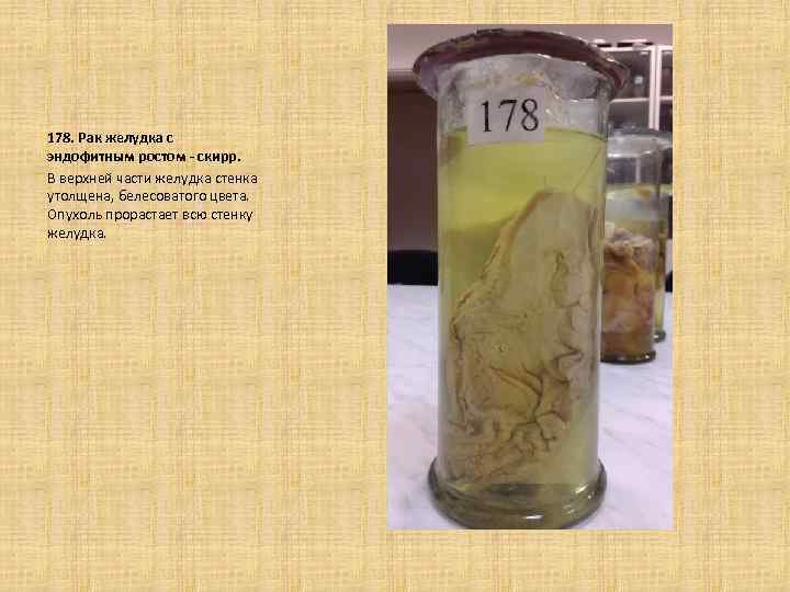 178. Рак желудка с эндофитным ростом - скирр. В верхней части желудка стенка утолщена,