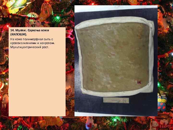 14. Муляж. Саркома кожи (КАПОШИ). На коже полиморфная сыпь с кровоизлияниями и некрозом. Мультицентрический