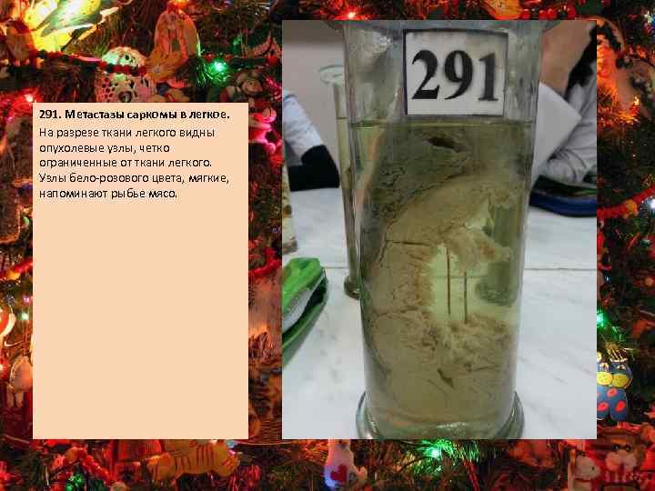 291. Метастазы саркомы в легкое. На разрезе ткани легкого видны опухолевые узлы, четко ограниченные