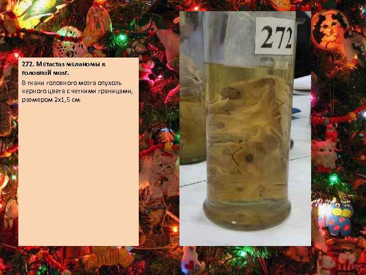 272. Метастаз меланомы в головной мозг. В ткани головного мозга опухоль черного цвета с