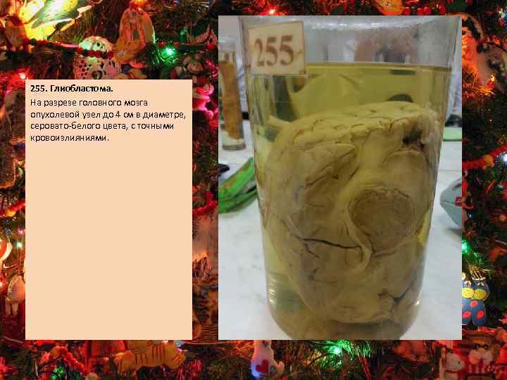 255. Глиобластома. На разрезе головного мозга опухолевой узел до 4 см в диаметре, серовато-белого
