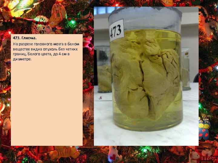 473. Глиома. На разрезе головного мозга в белом веществе видна опухоль без четких границ,