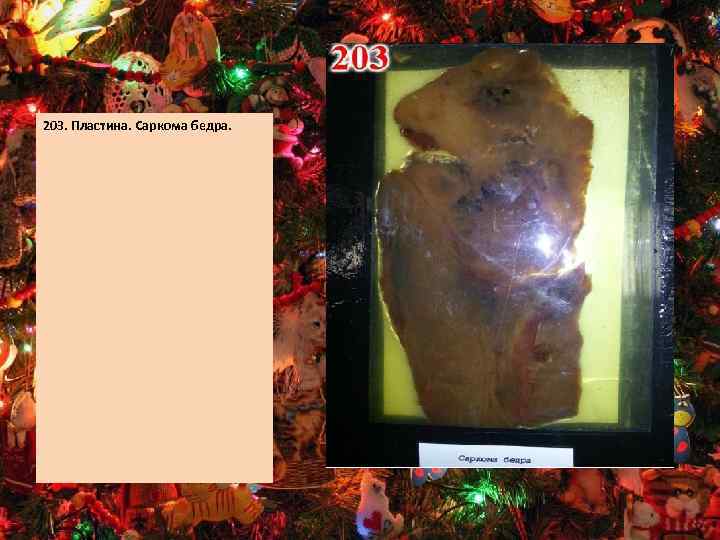 203. Пластина. Саркома бедра. 
