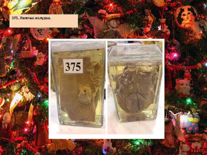 375. Липома желудка. 