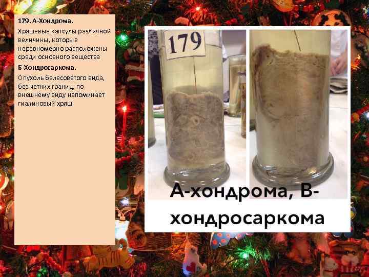 179. А-Хондрома. Хрящевые капсулы различной величины, которые неравномерно расположены среди основного вещества Б-Хондросаркома. Опухоль