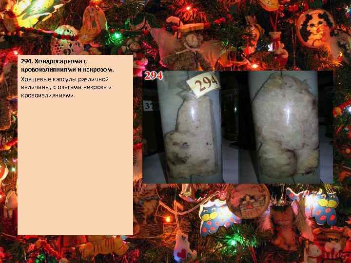 294. Хондросаркома с кровоизлияниями и некрозом. Хрящевые капсулы различной величины, с очагами некроза и