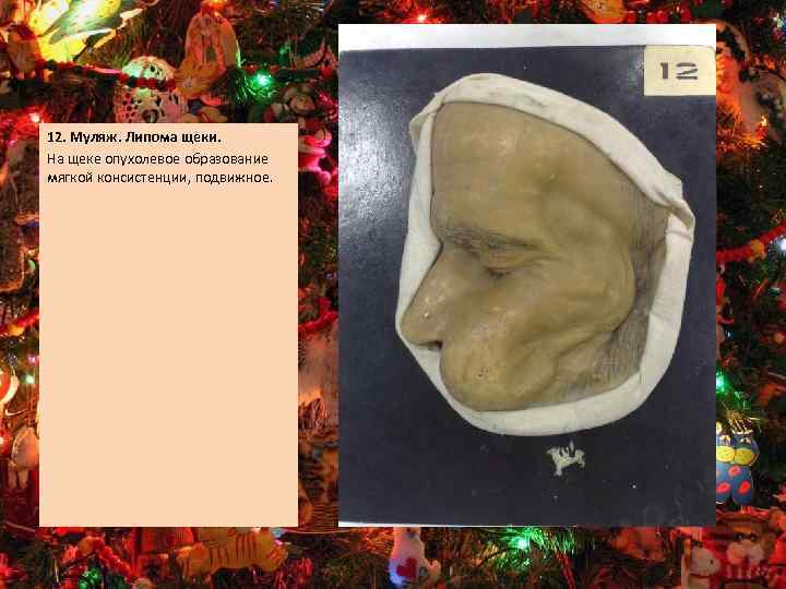 12. Муляж. Липома щеки. На щеке опухолевое образование мягкой консистенции, подвижное. 
