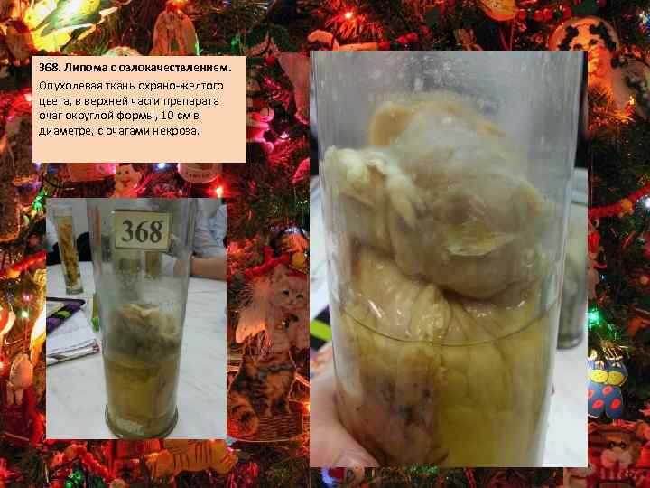 368. Липома с озлокачествлением. Опухолевая ткань охряно-желтого цвета, в верхней части препарата очаг округлой