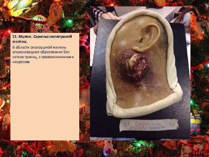 21. Муляж. Саркома околоушной железы. В области околоушной железы опухолевидное образование без четких границ,