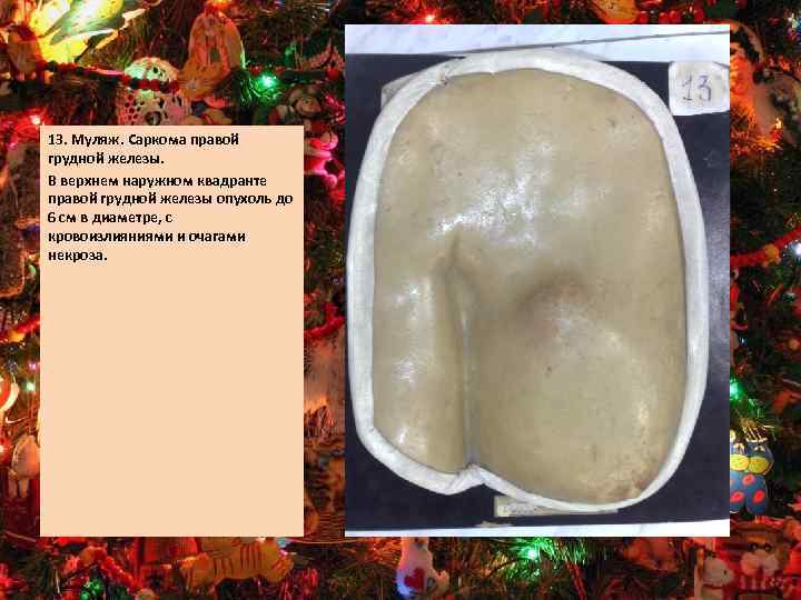13. Муляж. Саркома правой грудной железы. В верхнем наружном квадранте правой грудной железы опухоль