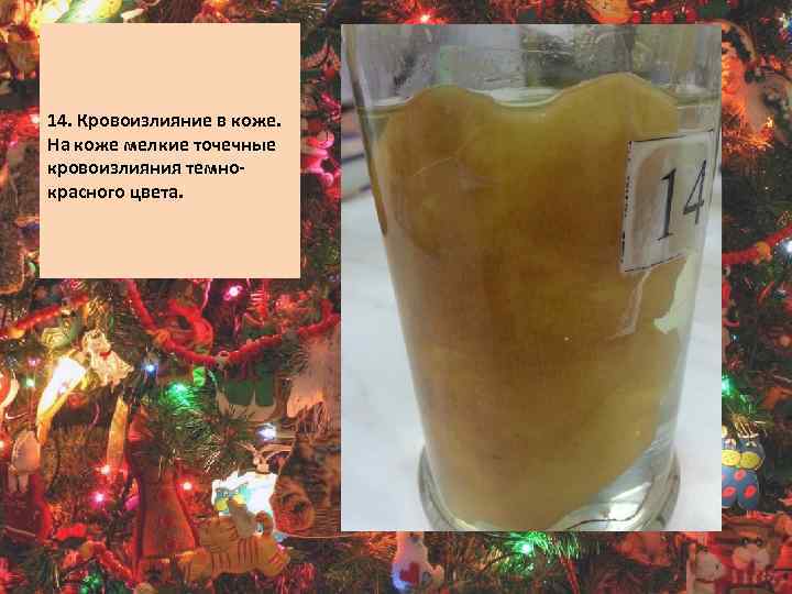  14. Кровоизлияние в коже. На коже мелкие точечные кровоизлияния темнокрасного цвета. 