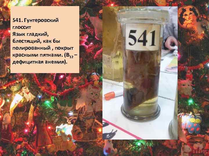 541. Гунтеровский глоссит Язык гладкий, блестящий, как бы полированный , покрыт красными пятнами. (В