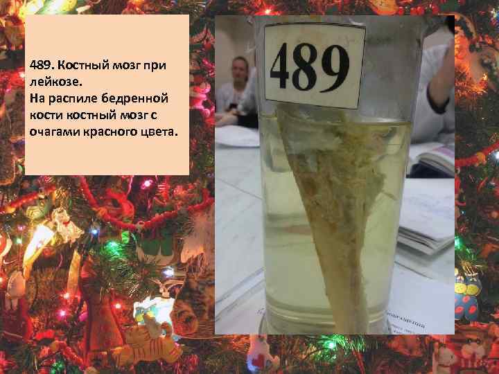 489. Костный мозг при лейкозе. На распиле бедренной кости костный мозг с очагами красного