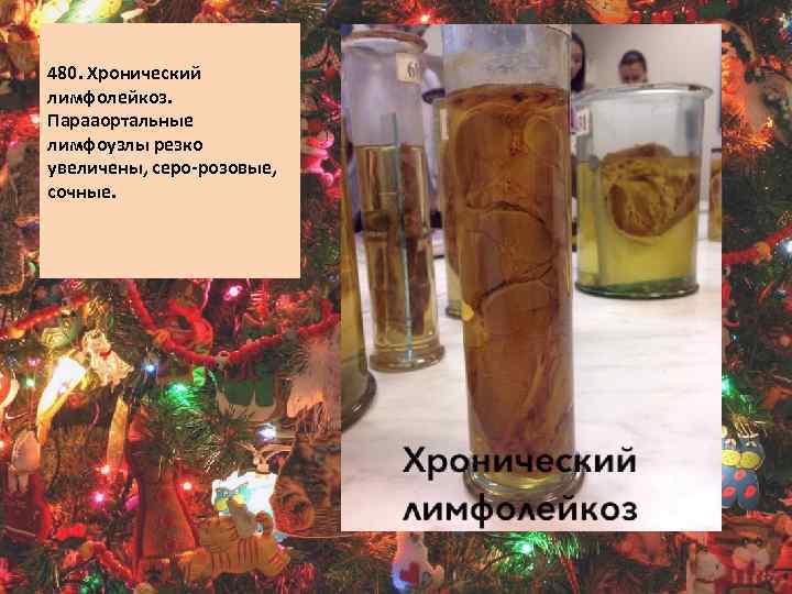 480. Хронический лимфолейкоз. Парааортальные лимфоузлы резко увеличены, серо-розовые, сочные. 