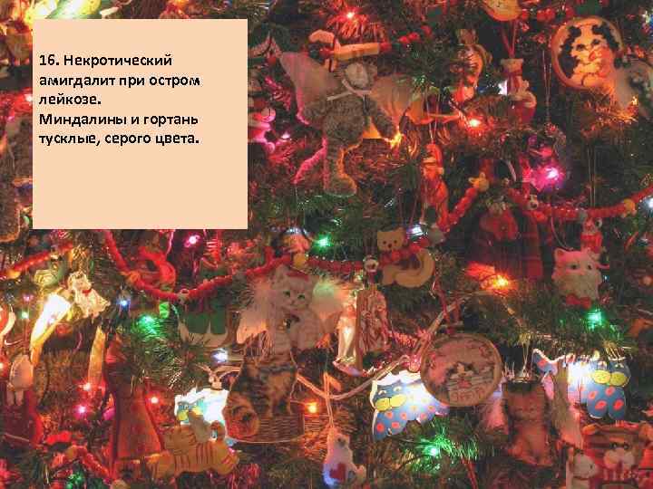 16. Некротический амигдалит при остром лейкозе. Миндалины и гортань тусклые, серого цвета. 