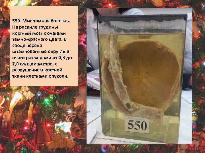 550. Миеломная болезнь. На распиле грудины костный мозг с очагами темно-красного цвета. В своде