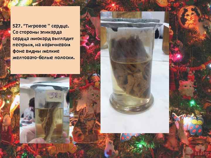  527. “Тигровое ” сердце. Со стороны эпикарда сердца миокард выглядит пестрым, на коричневом