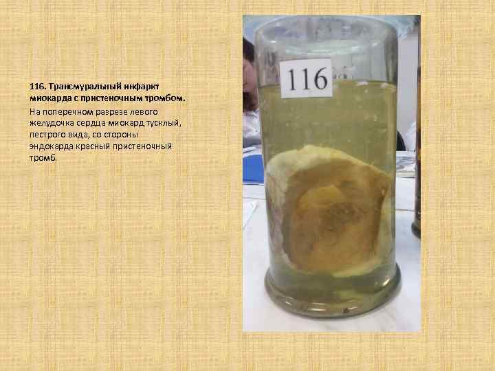 116. Трансмуральный инфаркт миокарда с пристеночным тромбом. На поперечном разрезе левого желудочка сердца миокард