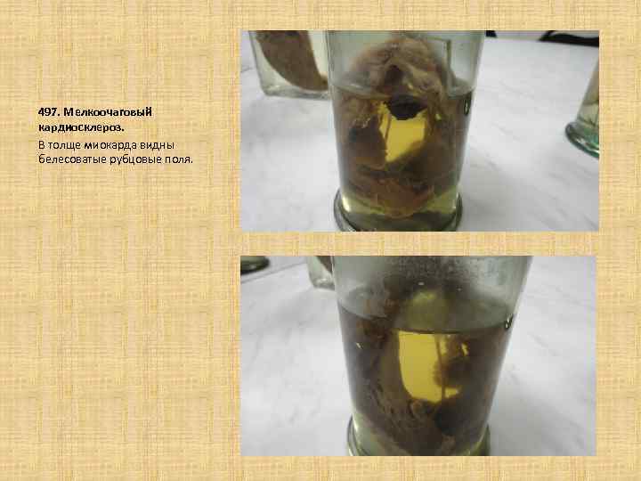 497. Мелкоочаговый кардиосклероз. В толще миокарда видны белесоватые рубцовые поля. 