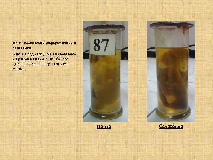 87. Ишемический инфаркт почки и селезенки. В почке под капсулой и в селезенке на