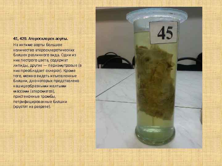 45, 429. Атеросклероз аорты. На интиме аорты большое количество атеросклеротических бляшек различного вида. Одни