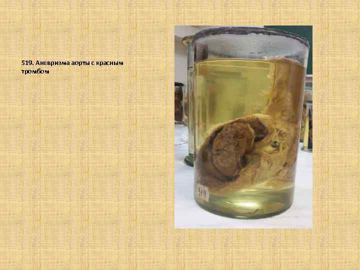 519. Аневризма аорты с красным тромбом 