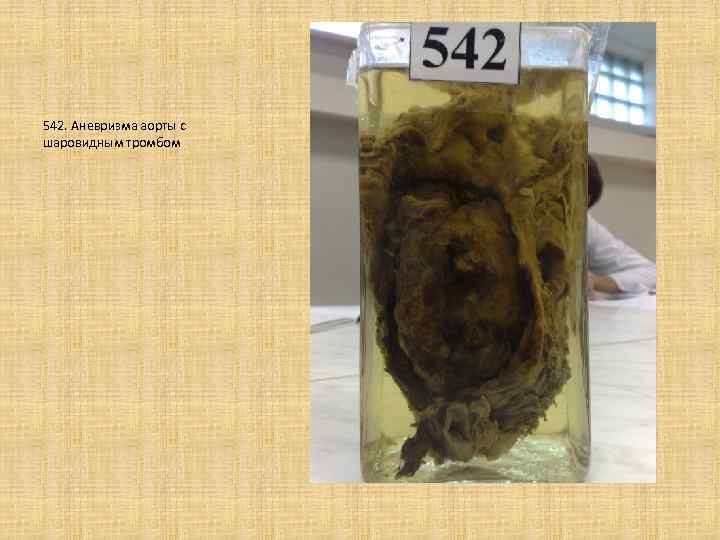 542. Аневризма аорты с шаровидным тромбом 