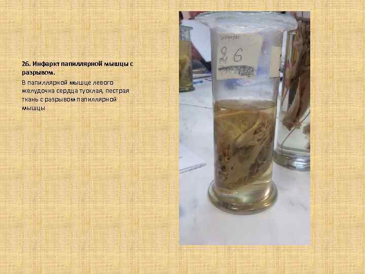 26. Инфаркт папиллярной мышцы с разрывом. В папиллярной мышце левого желудочка сердца тусклая, пестрая