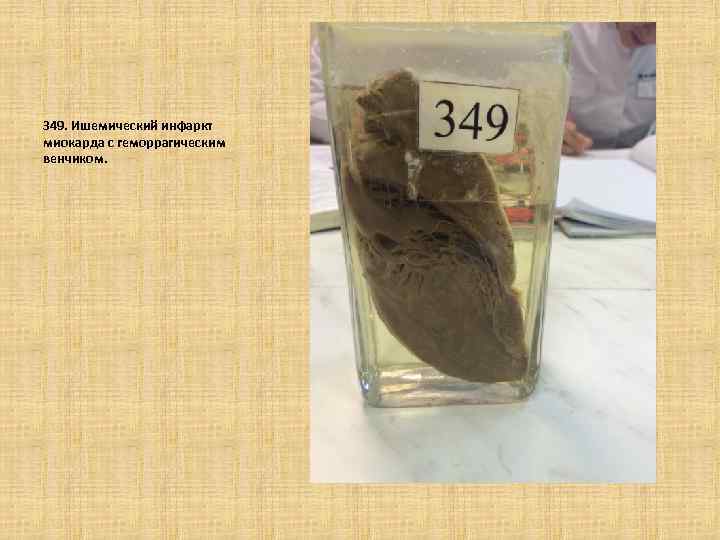 349. Ишемический инфаркт миокарда с геморрагическим венчиком. 