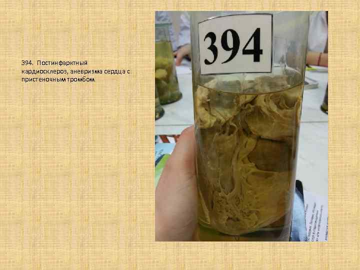 394. Постинфарктный кардиосклероз, аневризма сердца с пристеночным тромбом. 