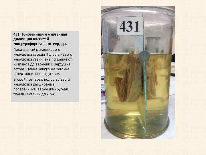 431. Тоногеннная и миогенная дилятация полостей гипертрофированного сердца. Продольный разрез левого желудочка сердца Полость