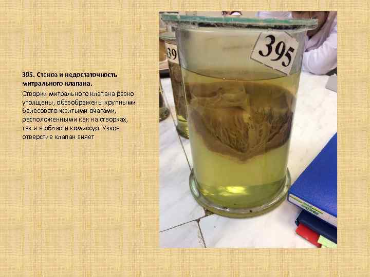  395. Стеноз и недостаточность митрального клапана. Створки митрального клапана резко утолщены, обезображены крупными
