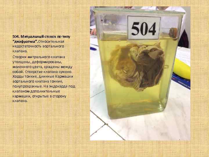 504. Митральный стеноз по типу “диафрагмы”. Относительная недостаточность аортального клапана. Створки митральиого клапана утолщены,