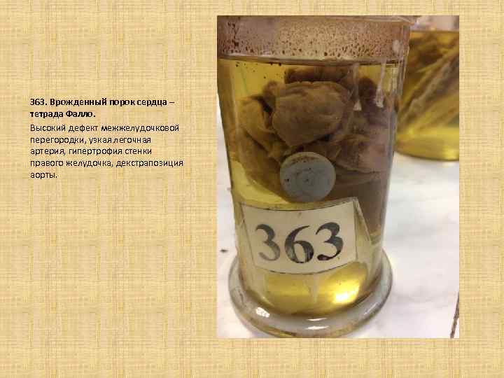  363. Врожденный порок сердца – тетрада Фалло. Высокий дефект межжелудочковой перегородки, узкая легочная