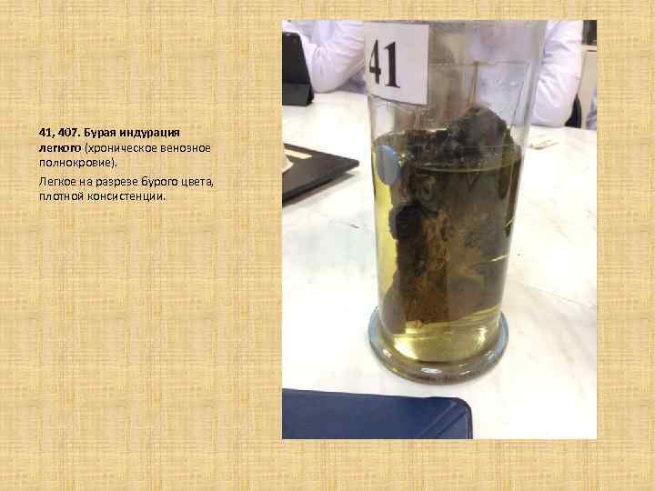  41, 407. Бурая индурация легкого (хроническое венозное полнокровие). Легкое на разрезе бурого цвета,