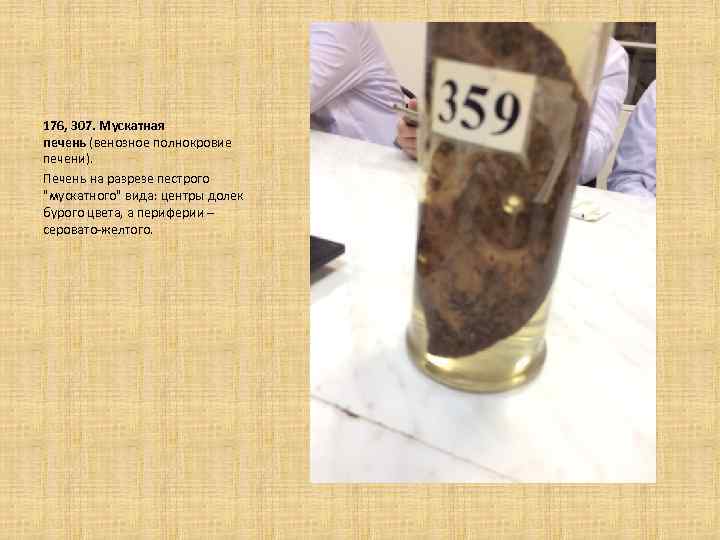 176, 307. Мускатная печень (венозное полнокровие печени). Печень на разрезе пестрого "мускатного" вида: центры