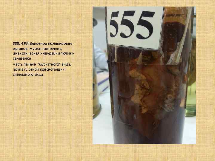  555, 479. Венозное полнокровие органов: мускатная печень, цианотическая индурация почки и селезенки. Часть