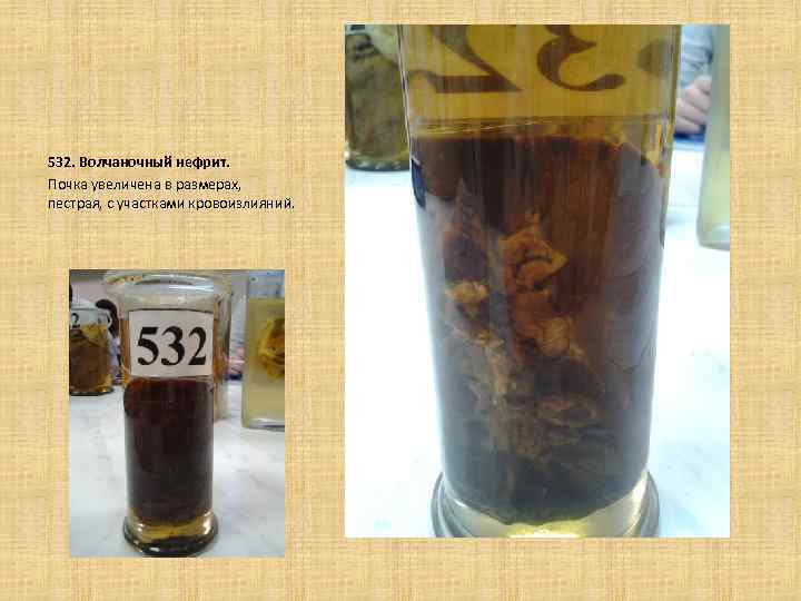  532. Волчаночный нефрит. Почка увеличена в размерах, пестрая, с участками кровоизлияний. 
